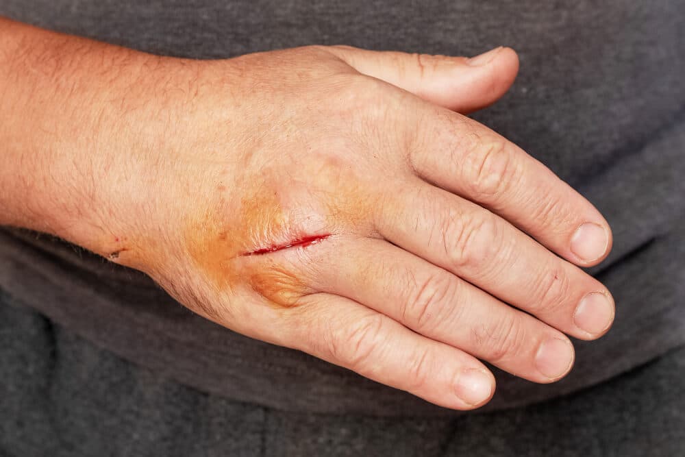 Soft Tissue Injury 104 Soft Tissue Injury